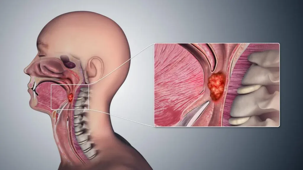 Throat cancer treatment in aurangabad