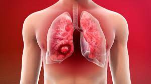 Lung Cancer treatment in aurangabad